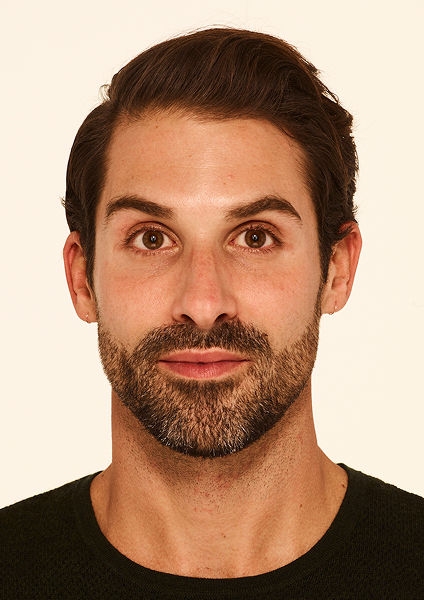Botox forehead lines, frown lines, crow's feet lines after - Stephen