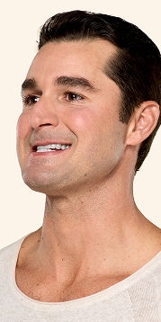 Botox neck and jaw after - Ben