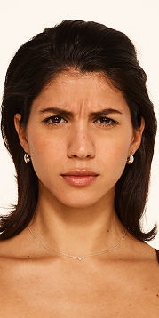 Botox forehead lines, frown lines, crow's feet lines before - Nicole