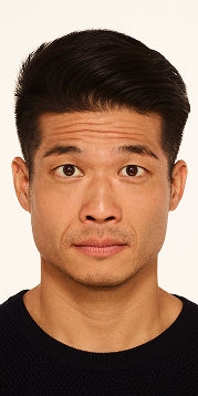 Botox forehead lines, frown lines, crow's feet lines before - Andrew