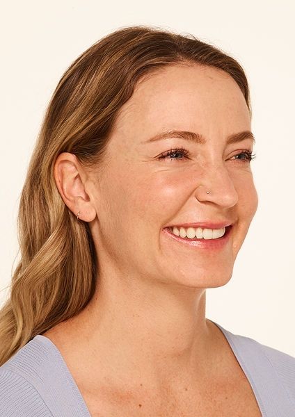 Botox forehead lines, frown lines, crow's feet lines before - Mandy