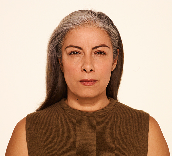 Botox frown lines after - Delfina