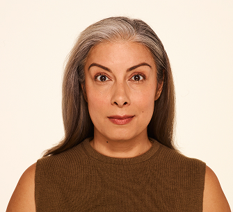 Botox forehead lines before - Delfina