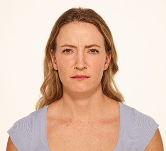 Botox frown lines before - Mandy