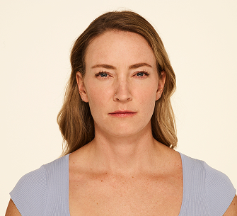 Botox frown lines after - Mandy