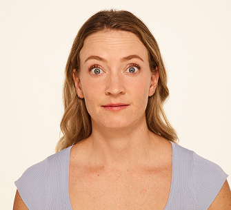 Botox forehead lines before - Mandy