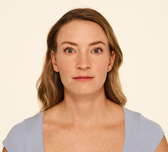Botox forehead lines before - Mandy